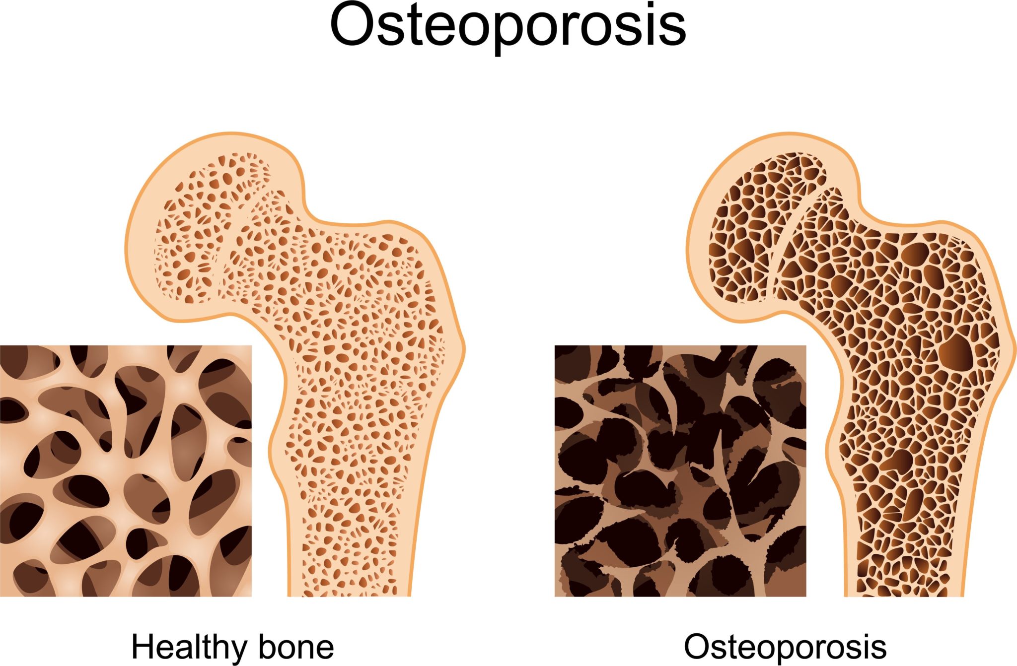 Resultado de imagen de osteoporosis